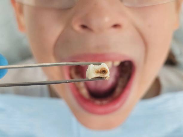 Best Emergency Dental Care for Abscessed Tooth in Middleburg Heights, OH